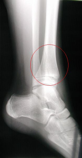Leg x-ray 1 - click for larger view
